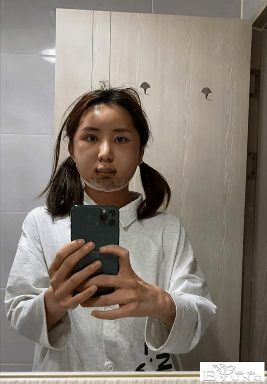 男网红整容后变伪娘，撞脸杨紫，称脸上有很多钛合钉过安检都会响-3.jpg