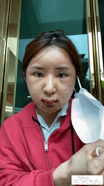男网红整容后变伪娘，撞脸杨紫，称脸上有很多钛合钉过安检都会响-4.jpg